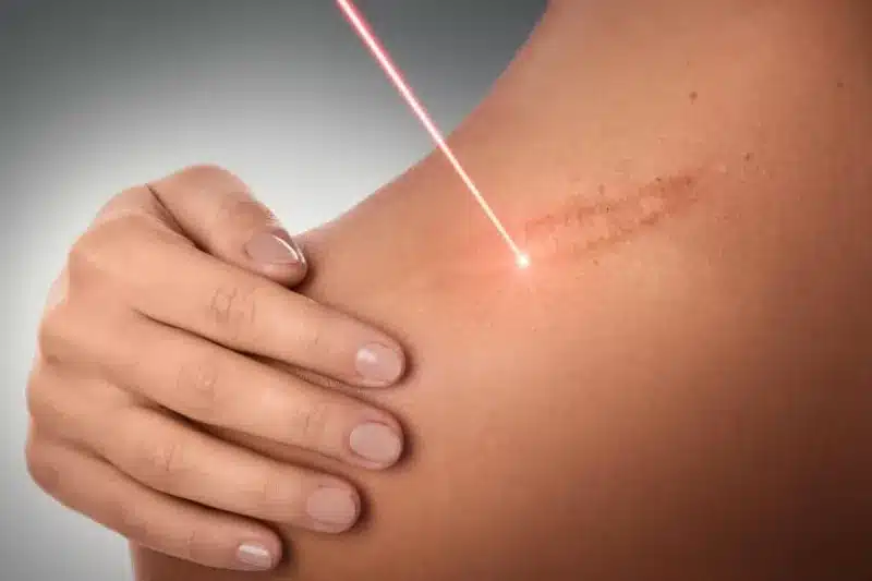 Traitement par laser médical au cabinet du Dr Perrod