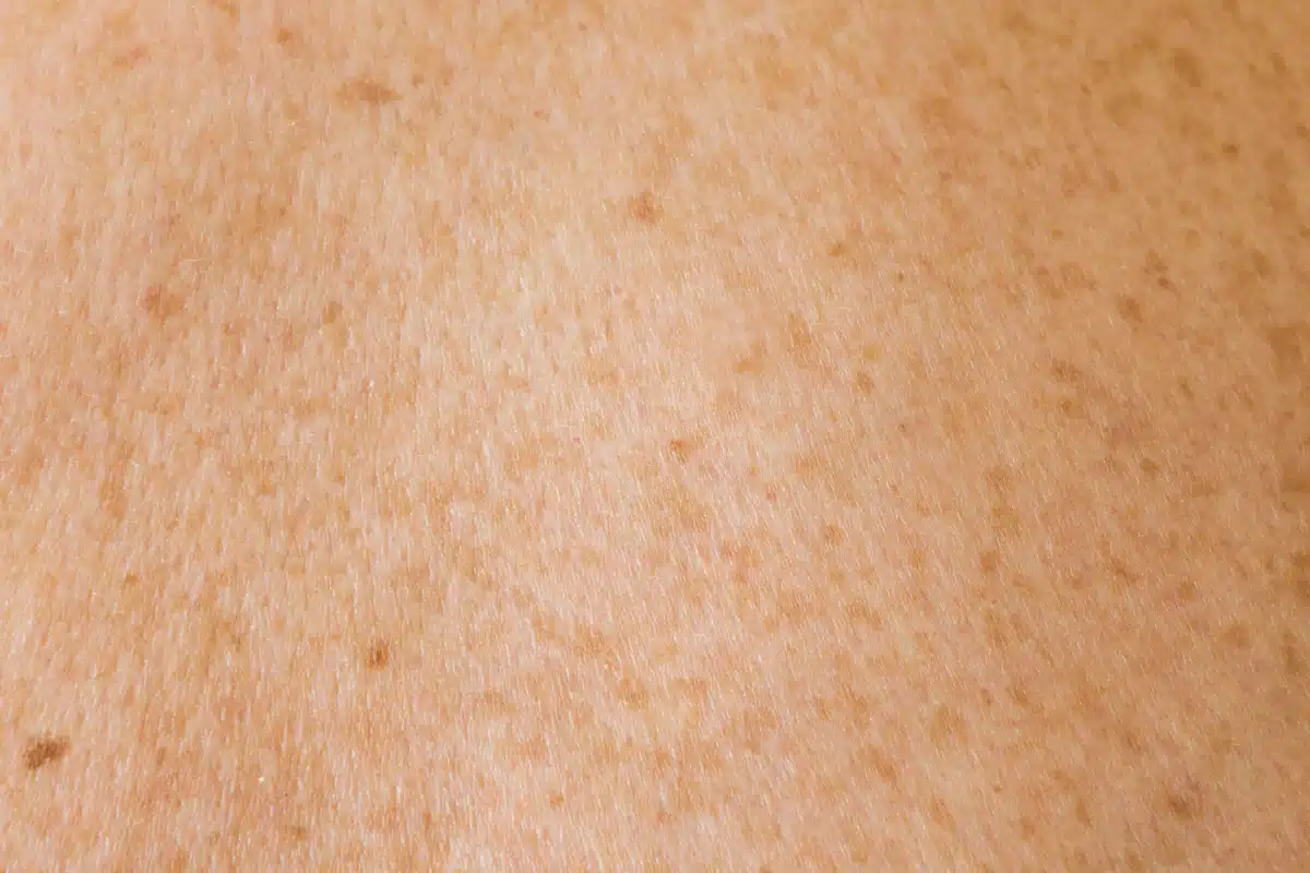 Peau du dos parsemée de grains de beauté à contrôler par dermatoscopie