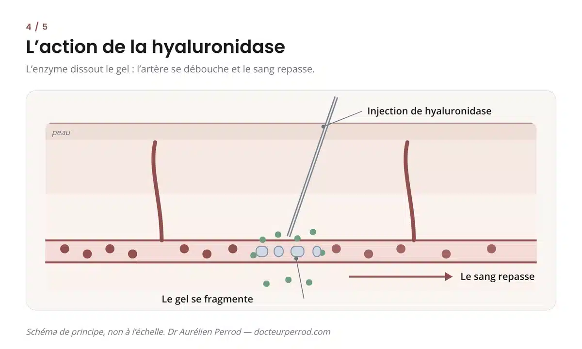 Schéma de l'action de la hyaluronidase : l'enzyme fragmente le gel d'acide hyaluronique et le sang repasse dans l'artère