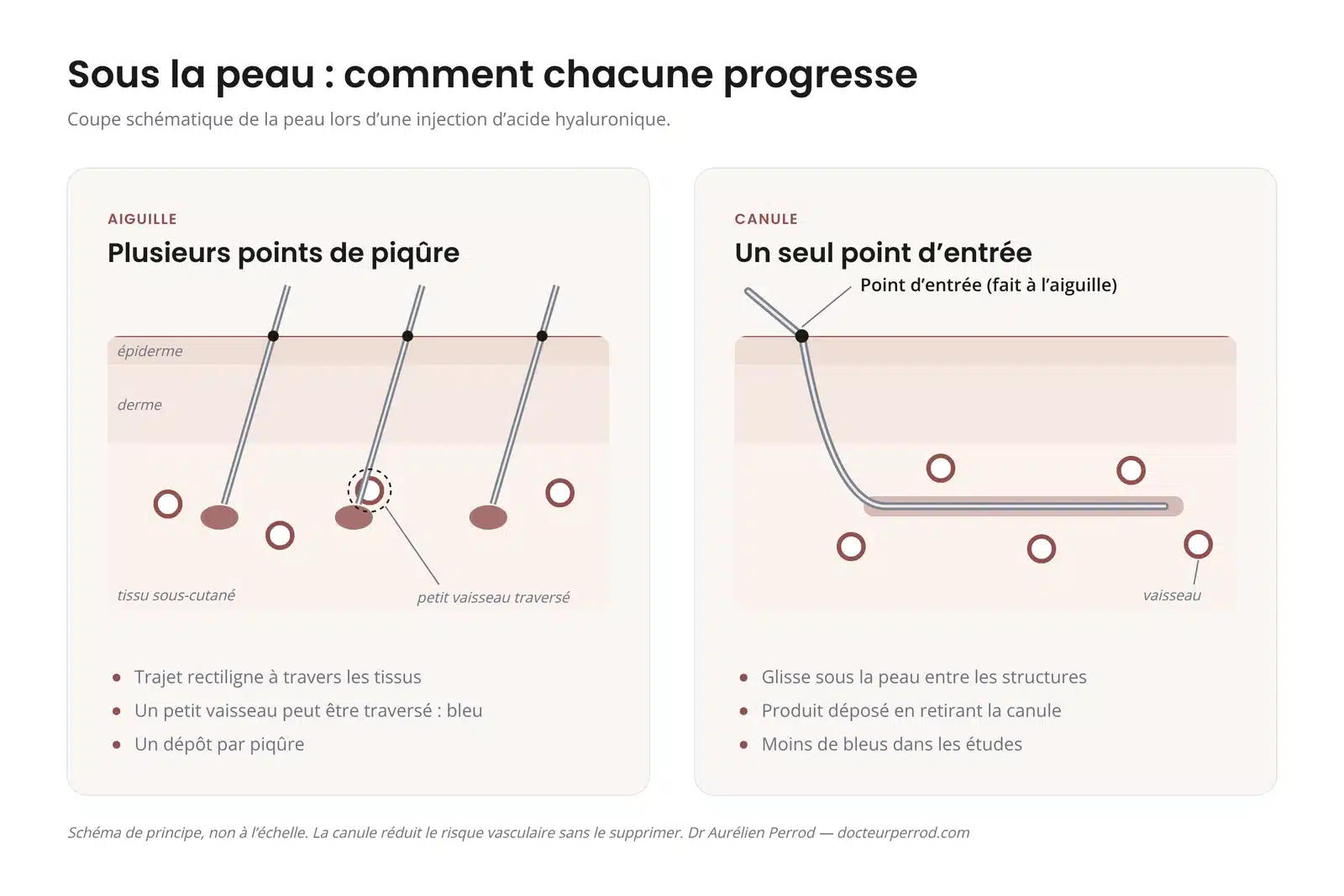 Schéma en coupe de la peau : plusieurs points de piqûre à l'aiguille, un seul point d'entrée à la canule