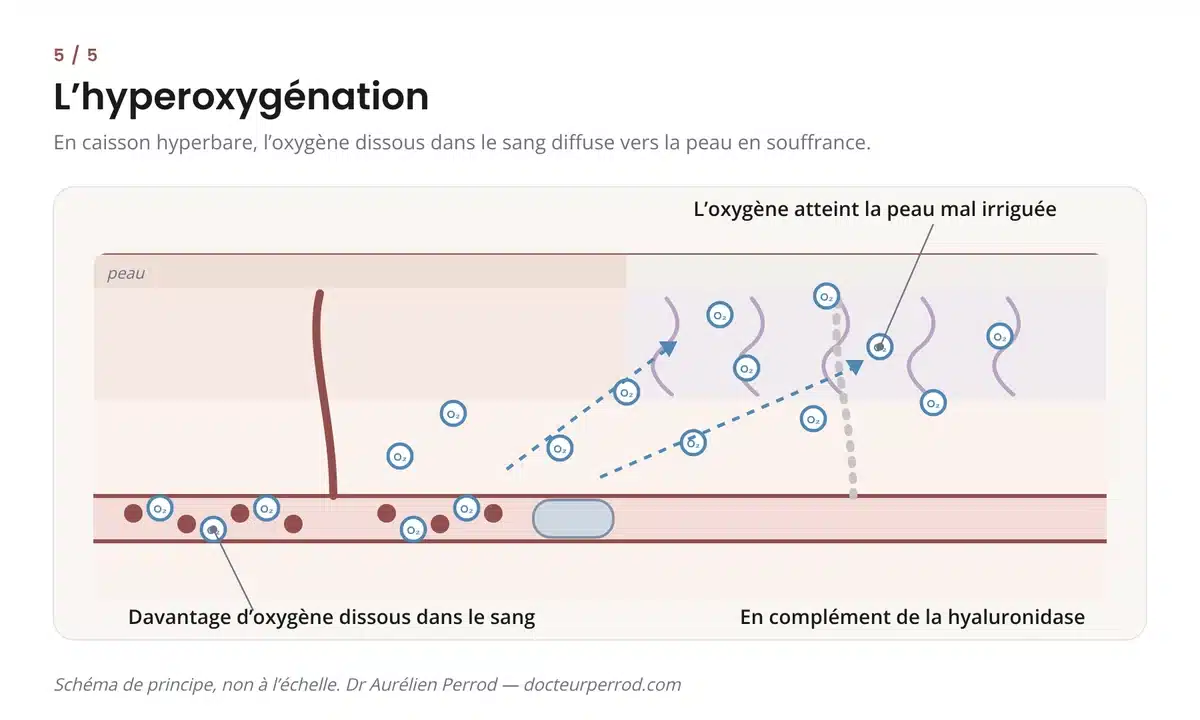 Schéma de l'hyperoxygénation en caisson hyperbare : l'oxygène dissous dans le sang diffuse vers la peau mal irriguée