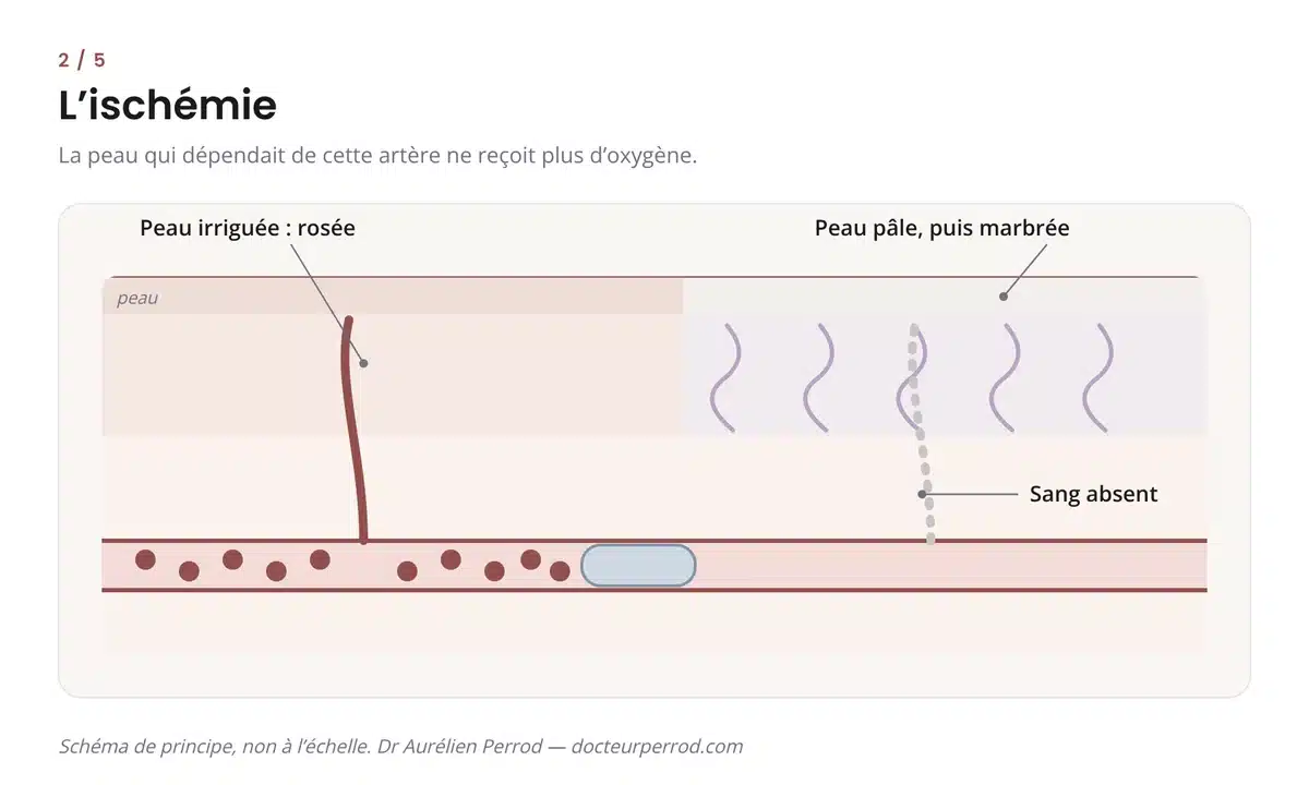 Schéma d'une ischémie : la peau située en aval de l'artère bouchée devient pâle puis marbrée