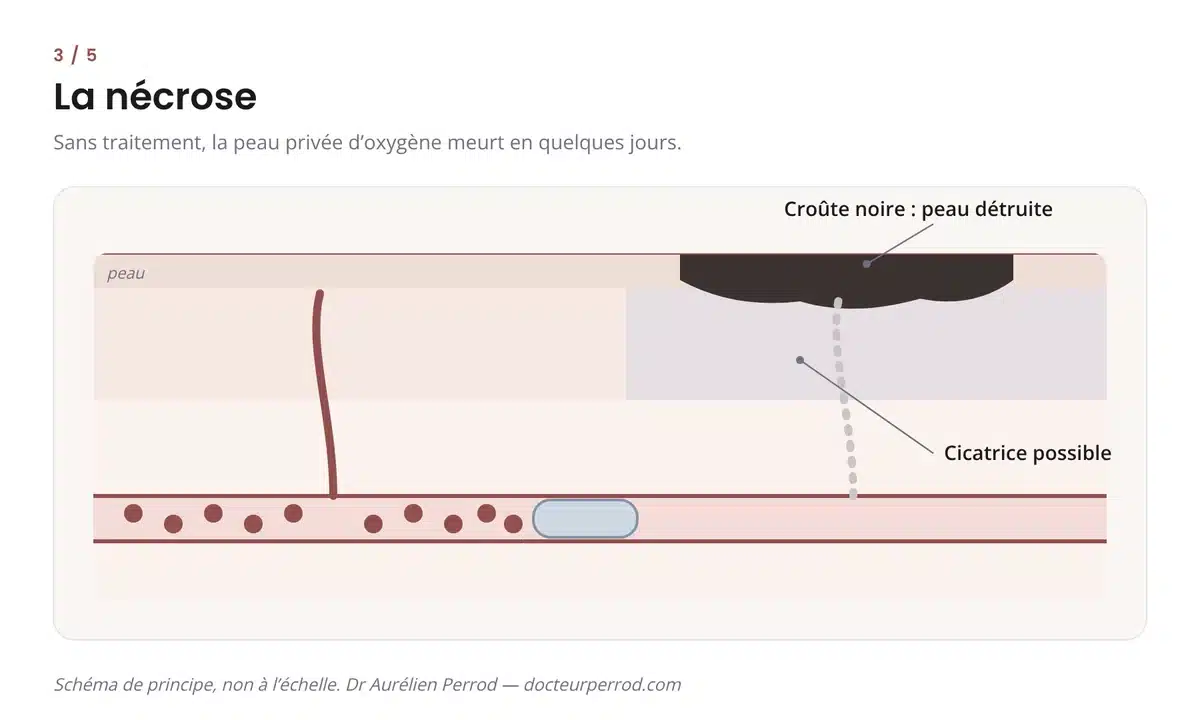 Schéma d'une nécrose : la peau privée d'oxygène forme une croûte noire