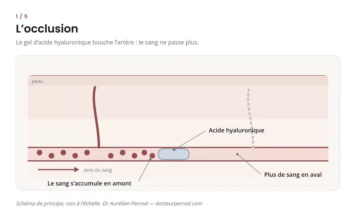 Schéma d'une occlusion artérielle : le gel d'acide hyaluronique bouche l'artère et le sang ne passe plus